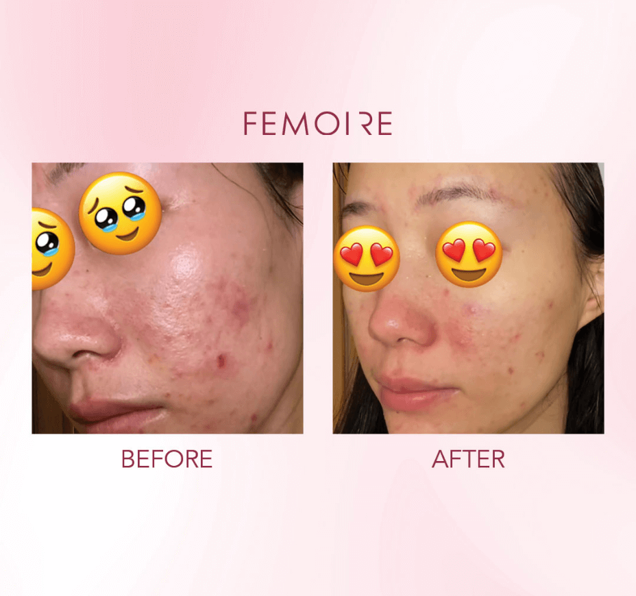 Femoire Testimonial_Before & After_3